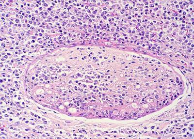 Linfoma neural y peri-neural asociado a herpesvirus