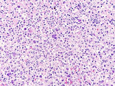 Linfoma neural y peri-neural con cuerpos de inclusión intranucleares de herpesvirus intralesionales