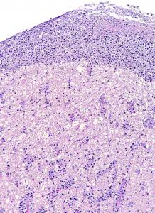 Linfoma en médula espinal asociado a herpesvirus