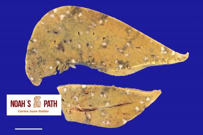 Hepatitis necrotizante debida a yersiniosis (pseudotuberculosis)