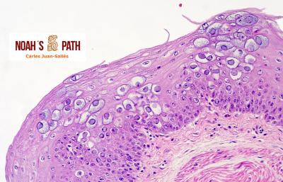 Cariomegalia e inclusiones poliomavirus en buche