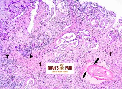 Proventriculitis proliferativa con nematodo espirúrido acuárido intralesional