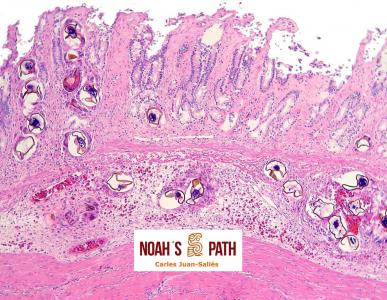 Gastritis por embolismo de huevos de tremátodos espirórquidos