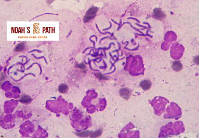 Pleuritis purulenta por <i>Pseudomonas luteola</i>