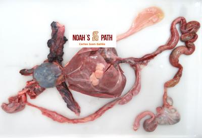 Cirrosis biliar complicada con varices pulmonares