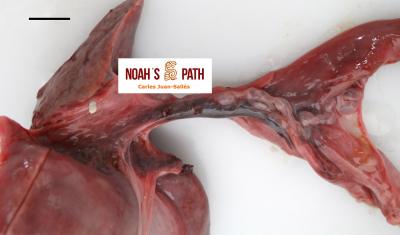 Colelito obstruyendo el colédoco en cirrosis biliar