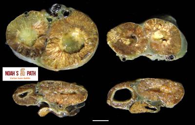 Neumonía supurativa y proliferativa bacteriana