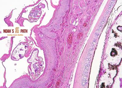 Acariasis epidérmica