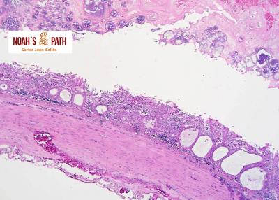 Enteropatía por agente radiomimético con infección bacteriana secundaria - intoxicación por fenbendazol