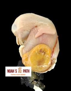 Malposición de saco vitelino sobre mpi, edema submandibular