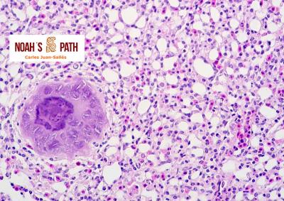 Infección por megaloesquizontes, leucocitozoonosis