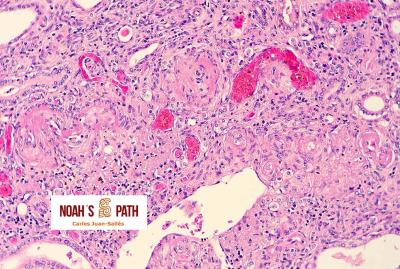 Nefroesclerosis arteriolar, degeneración fibrinoide arteriolar renal - hipertensión sistémica