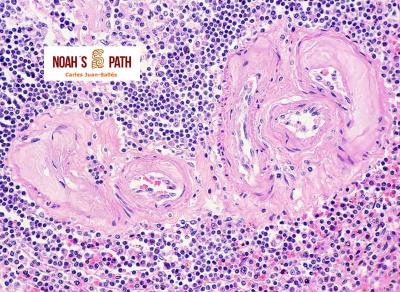 Arteriosclerosis esplénica - hipertensión sistémica