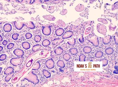 Enterobiasis invasiva, troglodytelliosis luminal