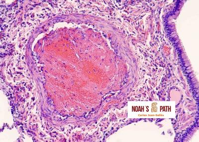 Trombosis arteria pulmonar