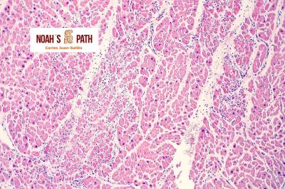 Degeneración e hipertrofia nuclear de cardiomiocitos, miocarditis