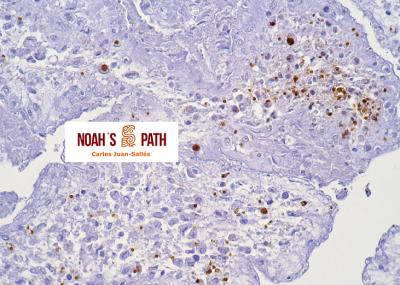 Placentitis, toxoplasmosis transplacentaria - Inmunohistoquímica Toxoplasma gondii