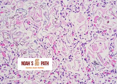 Aspiración de fluido amniótico secundaria a placentitis por toxoplasmosis