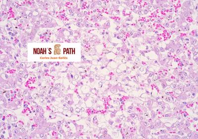 Hepatitis necrotizante fetal, toxoplasmosis transplacentaria