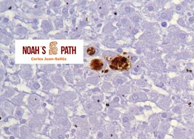 Toxoplasmosis transplacentaria, músculo esquelético - inmunohistoquímica