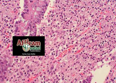 Enteritis granulomatosa, histoplasmosis