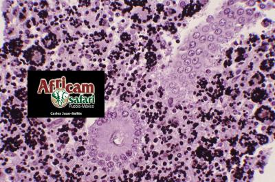 Enteritis granulomatosa, histoplasmosis - tinción GMS