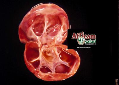 Hidronefrosis por aplasia segmental uréter 