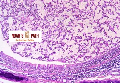 Bronquitis purulenta, Pseudomonas luteola
