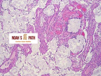 Mediastinitis piogranulomatosa, Pseudomonas luteola
