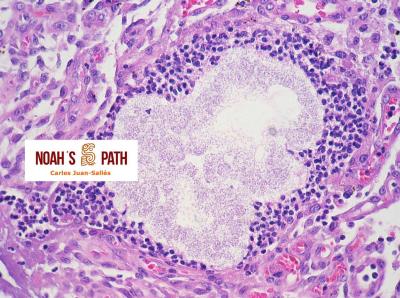 Mediastinitis piogranulomatosa, Pseudomonas luteola
