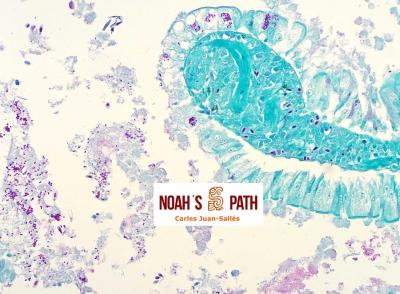 Encefalitozoonosis (<i>E. hellem</i>), infección intestinal - tinción Stamp