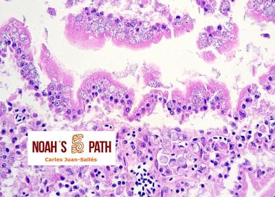 Encefalitozoonosis (<i>E. hellem</i>), infección intestinal