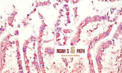 Encefalitozoonosis (<i>E. hellem</i>), infección intestinal - tinción Gram