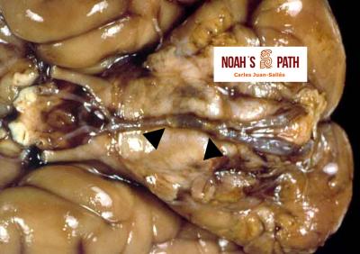 Ateromatosis en arterias basilar y vertebrales (base encéfalo)