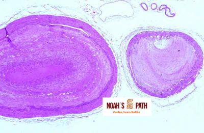 Ateromatosis en arterias basilar y vertebrales (base encéfalo)