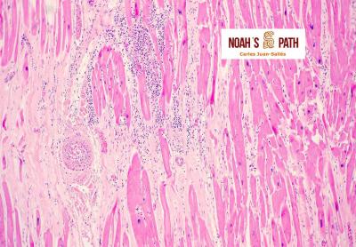 Fibrosis miocárdica, miocarditis