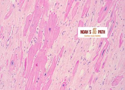 Fibrosis miocárdica, hipertrofia nuclear de cardiomiocitos