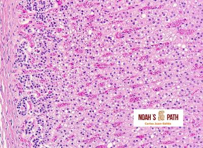 Respuesta estrés crónico - adrenal