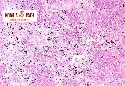 Hemocromatosis hepática - prevención de enfermedades de componente nutricional