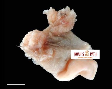 Pólipos adenomatosos proventriculares con nematodos espirúridos acuáridos en un lori