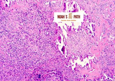 Imagen histológica de osteosarcoma en un conejo