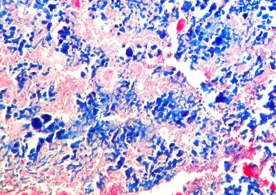 Producción de matriz cartilaginosa (azul) por un condrosarcoma en cobaya - tinción azul alcián