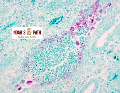 Nefritis túbulo-intersticial, clamidofilosis - tinción de Stamp