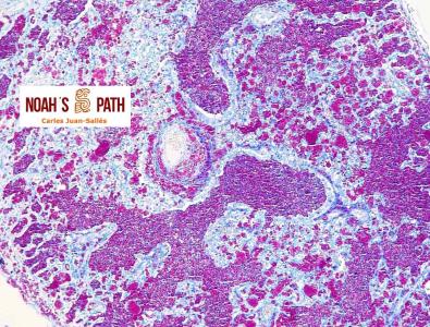 Neumonía por micobacteriosis diseminada - tinción Ziehl-Neelsen