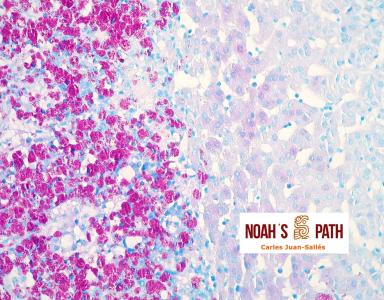 Adrenalitis por micobacteriosis sistémica - tinción de Ziehl-Neelsen