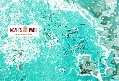 Laringitis necrótica fúngica, tinción Grocott