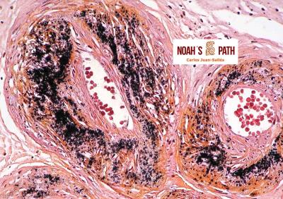 Mineralización arterial, ovario - tinción de von Kossa