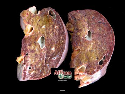 Congestión hepática pasiva crónica, insuficiencia cardiaca congestiva de lado derecho