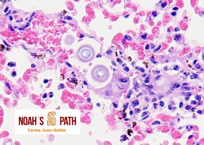 Embolismo de Cryptococcus en pulmón