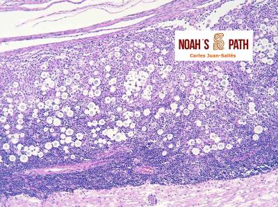 Meningomielitis por criptococosis